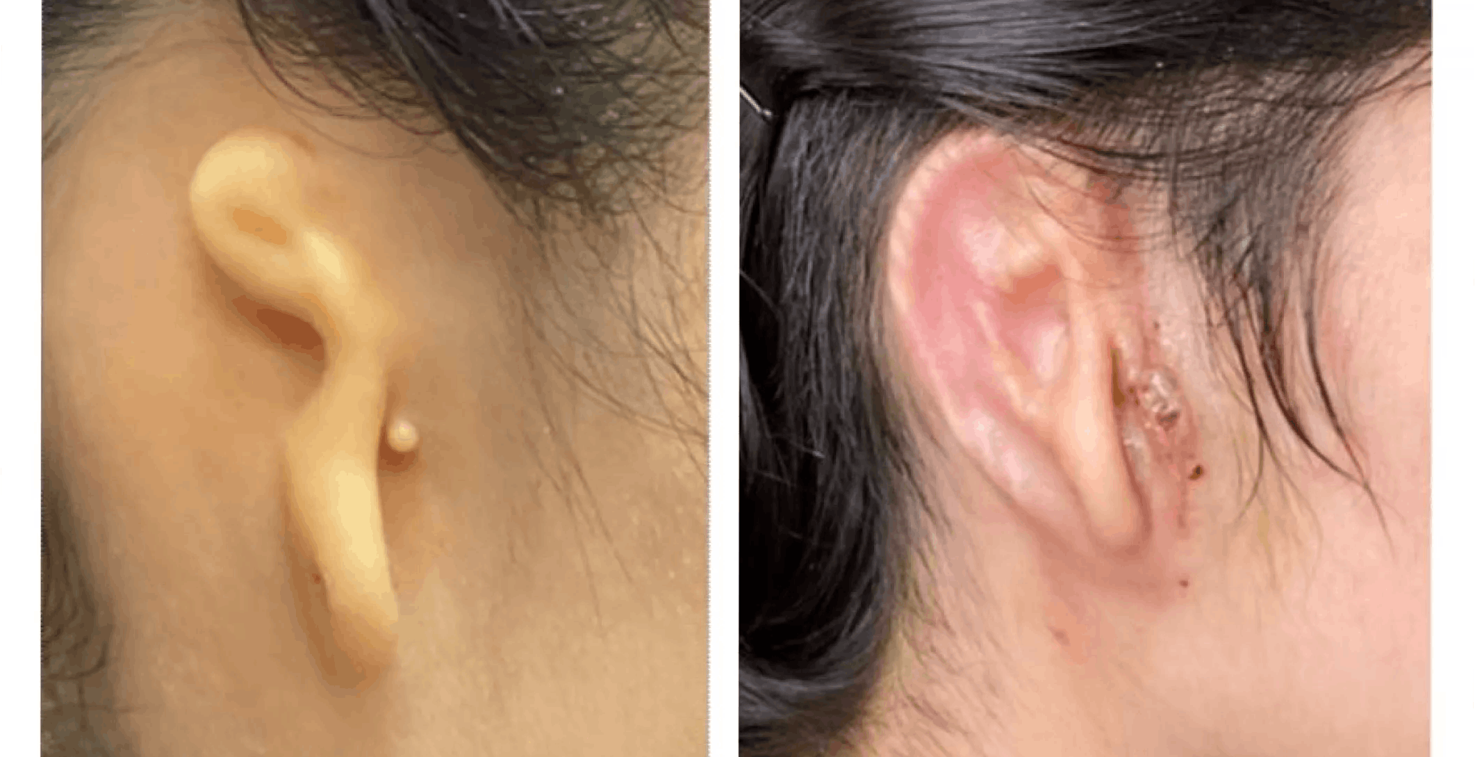 L’orecchio stampato in 3D con cellule cartilaginee cresce nel tempo. Una tecnica di bioprinting rivoluzionaria